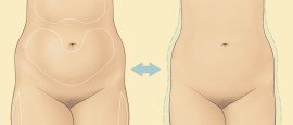 Surgery Lipo-Lipo Or Adipose Filling-Section Title.jpg
